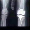 knee replacement.jpg